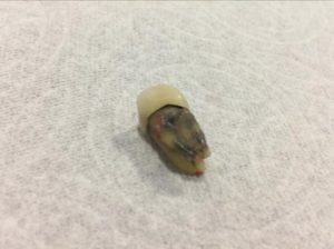Root Canal Treated Molar