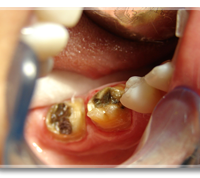 Same teeth after OZONE treatment.