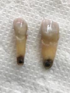 Root Canal Treated Molar 